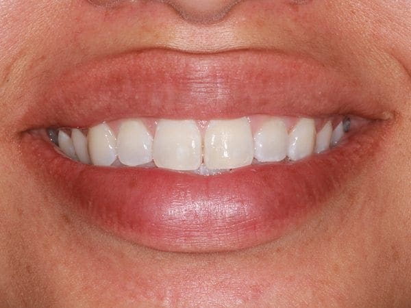 after cosmetic dentistry