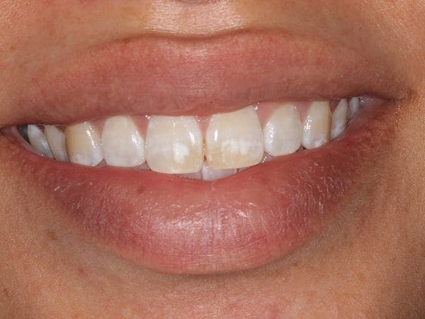 before cosmetic dentistry