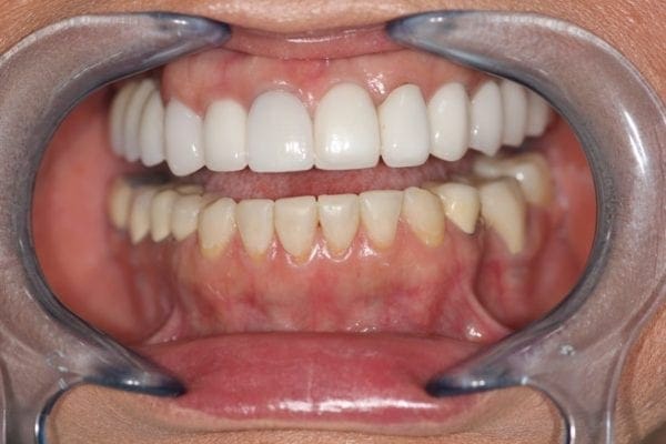after cosmetic dentistry