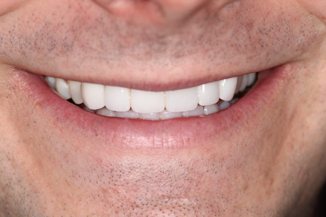 after cosmetic dentistry