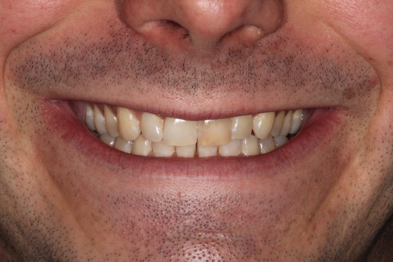 before cosmetic dentistry