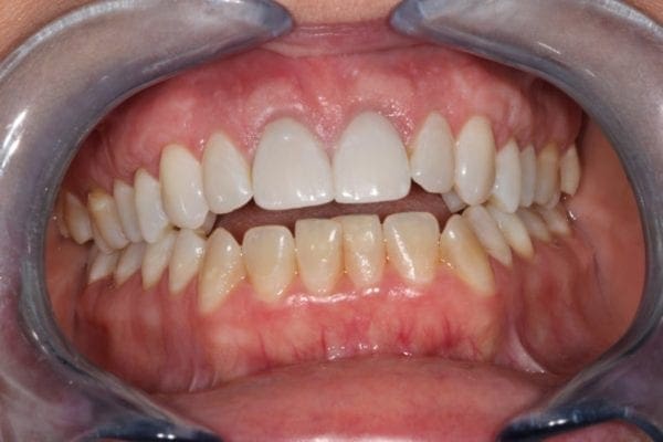 after cosmetic dentistry