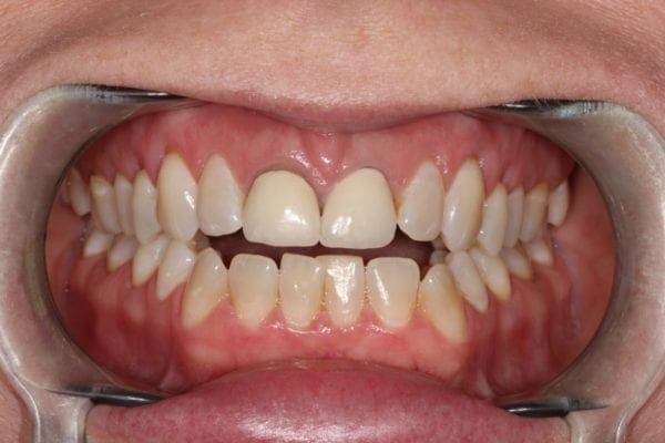 before cosmetic dentistry