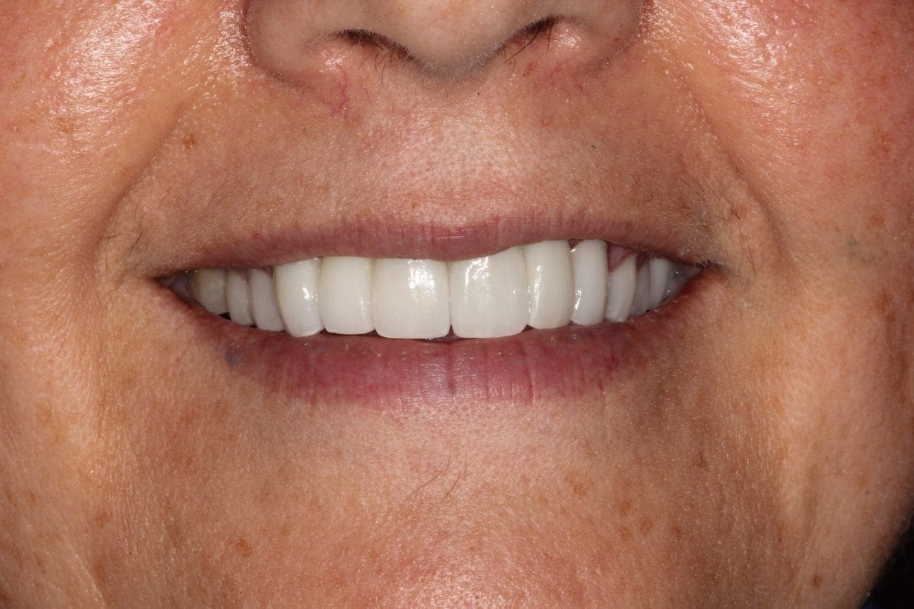 after cosmetic dentistry