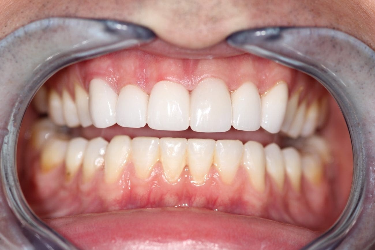 after cosmetic dentistry