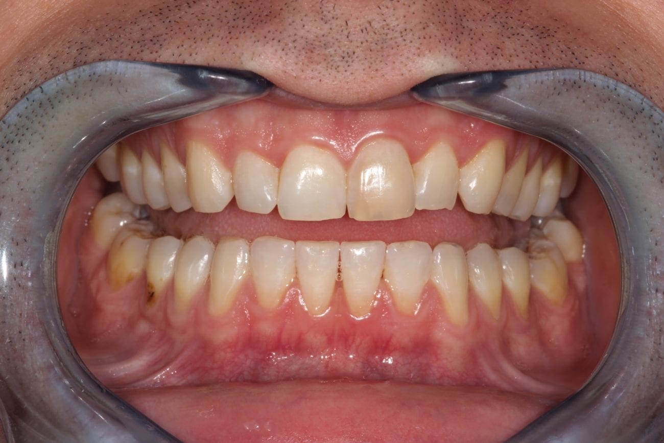 before cosmetic dentistry