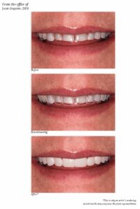 all on four dental implant-secured denture in Plano Texas