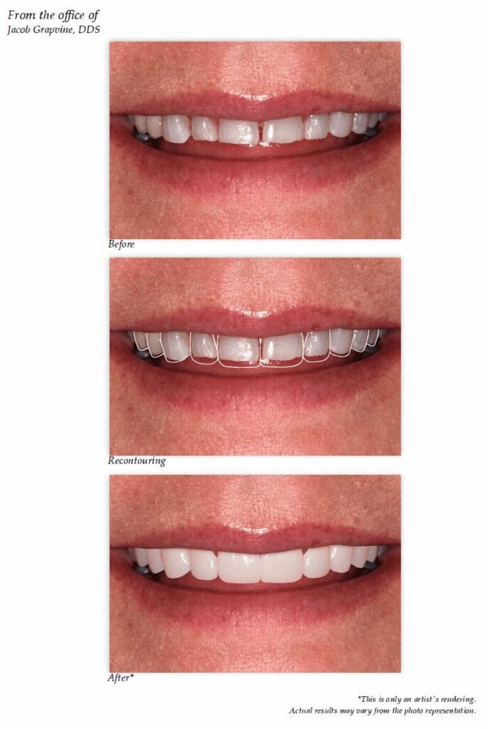 all on four dental implant-secured denture in Plano Texas