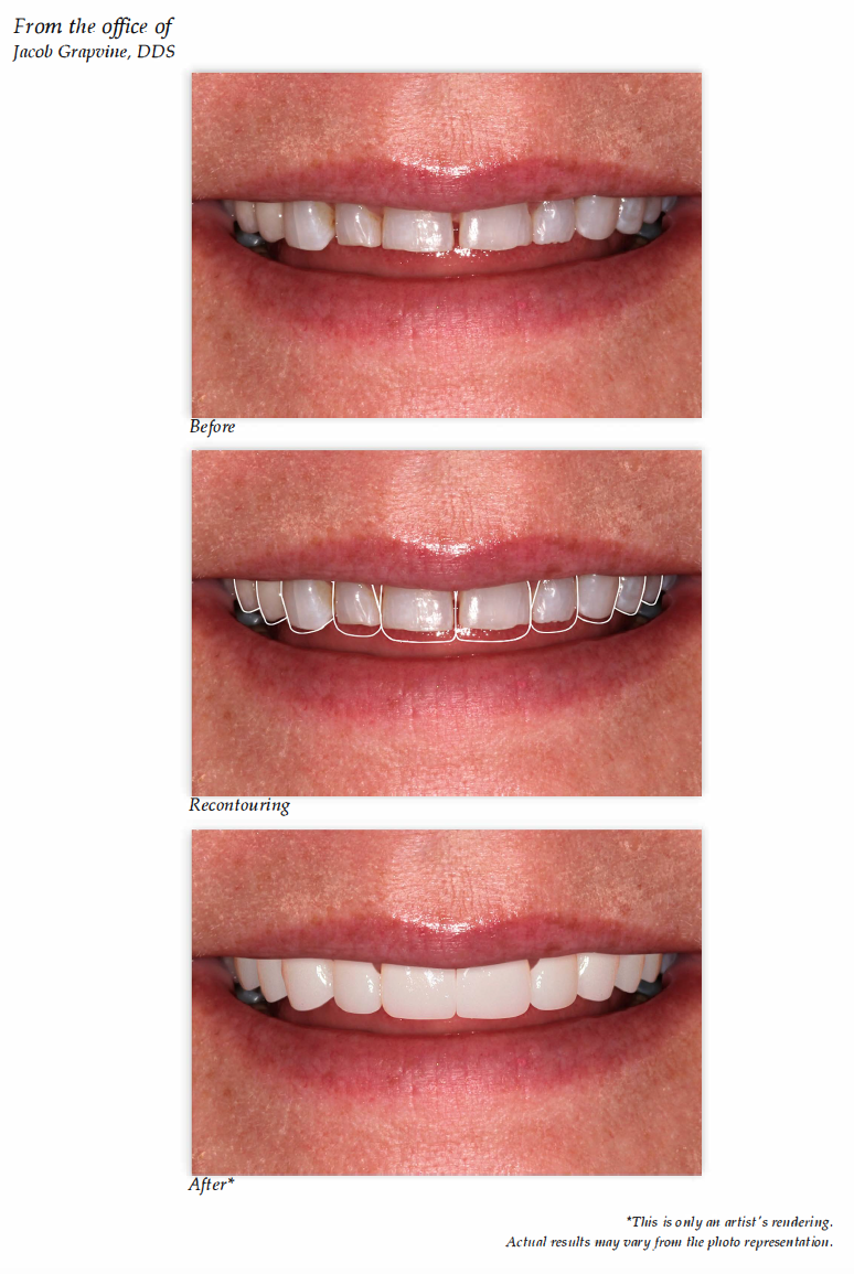 Digital Preview Of Your Smile Makeover