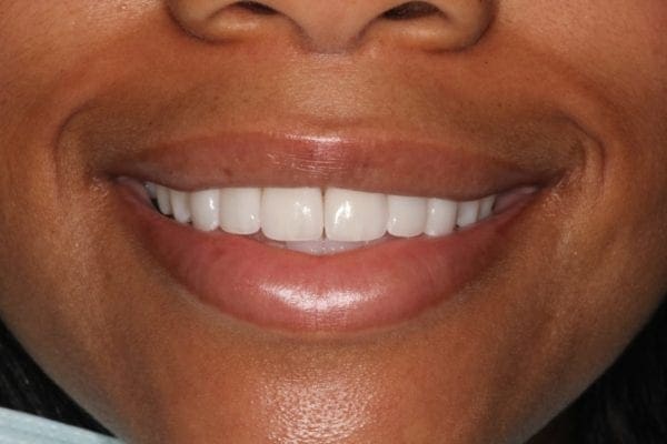 after cosmetic dentistry