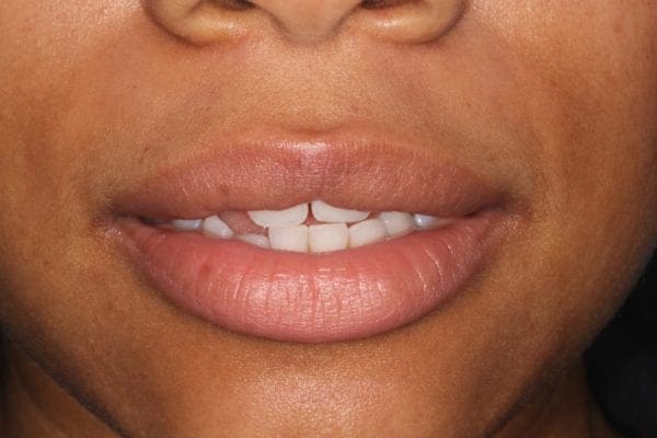 before cosmetic dentistry