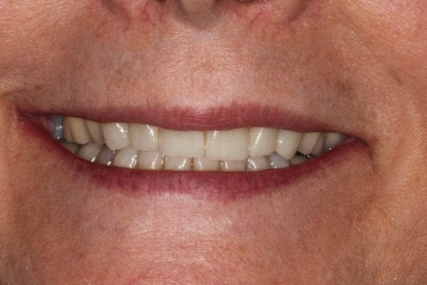 after cosmetic dentistry