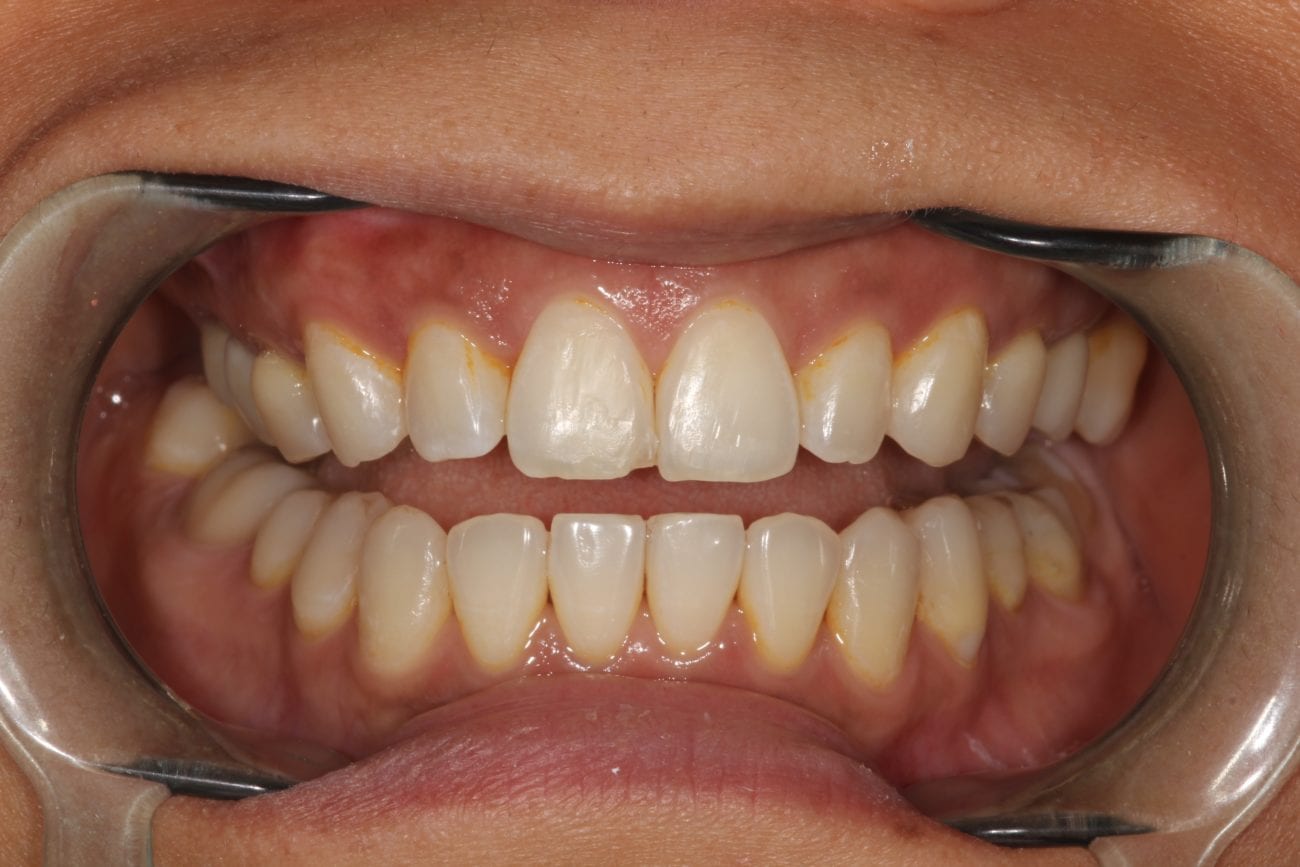 before cosmetic dentistry