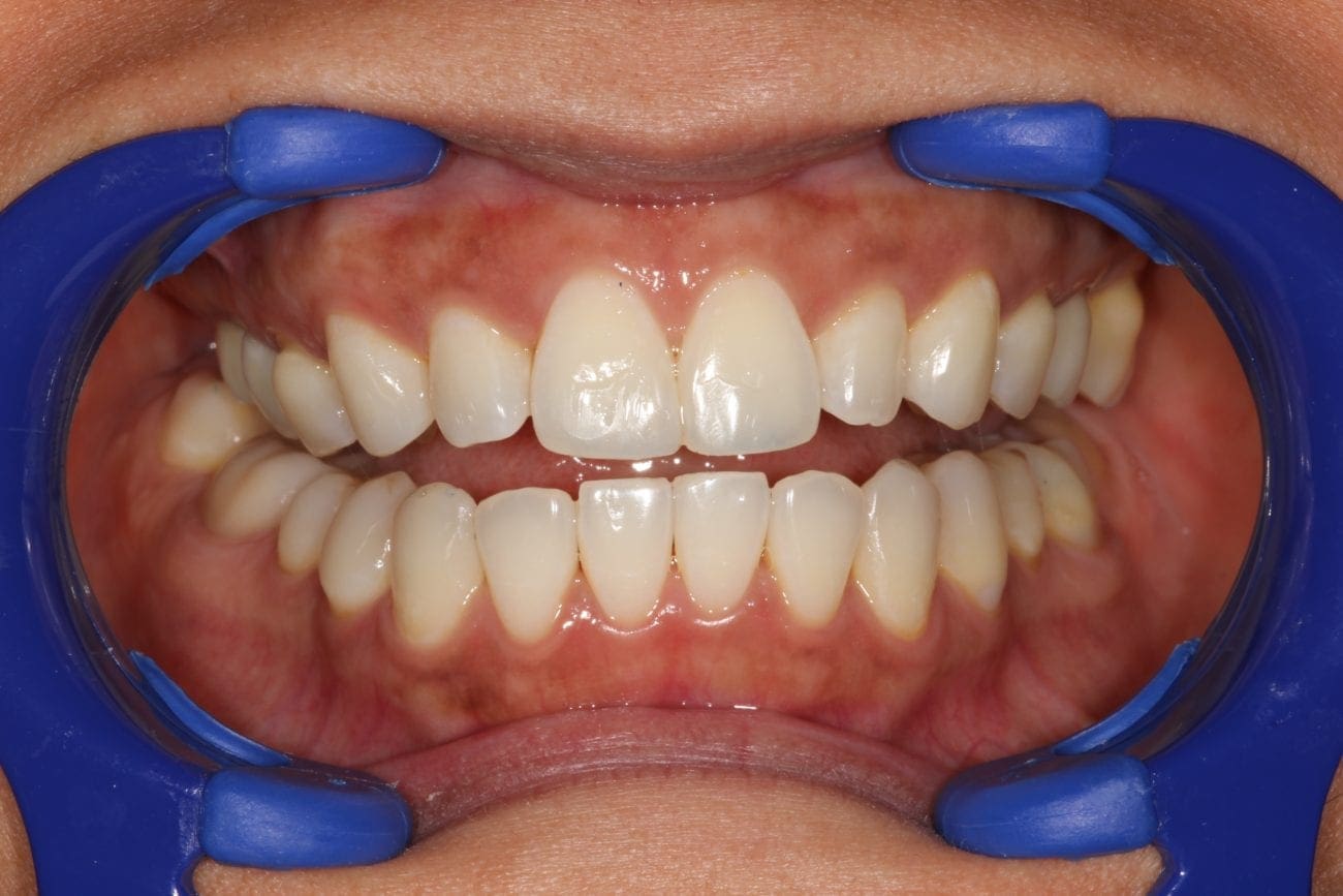 after cosmetic dentistry