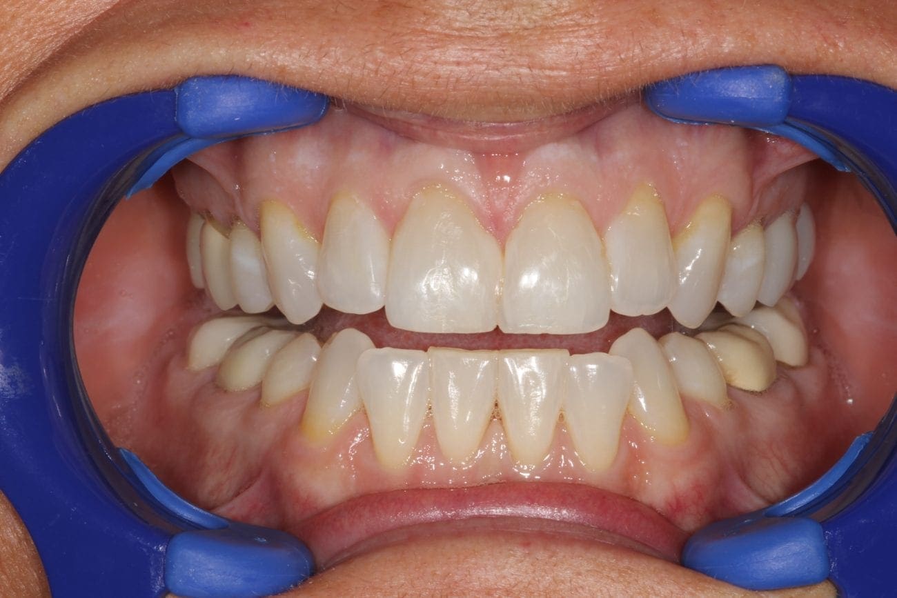 after cosmetic dentistry