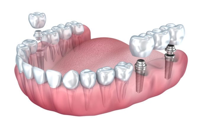 replace multiple missing teeth with dental implants in Plano, TX