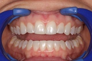 after cosmetic dentistry