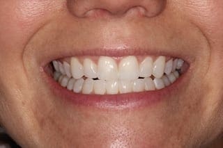 after cosmetic dentistry