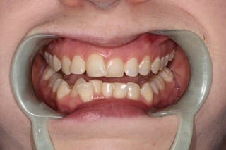 before cosmetic dentistry