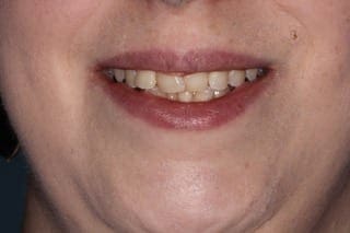 before cosmetic dentistry