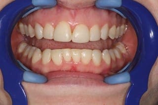 after cosmetic dentistry