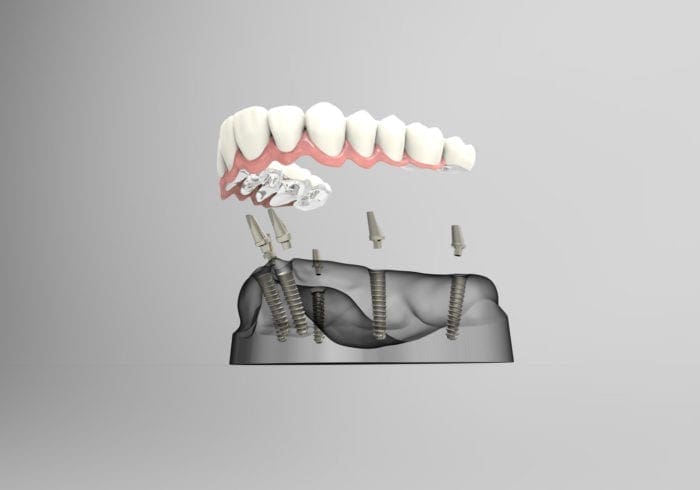 Affordable Implant-supported Dentures in Plano Texas