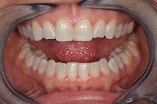 Before Invisalign in Dallas Texas