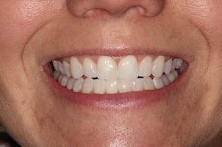 After Invisalign in Plano Texas