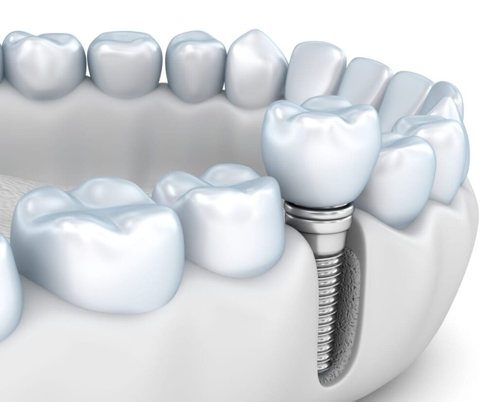 implant dentistry in plano tx