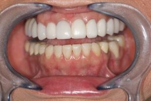 Dental Crowns in Plano, Texas