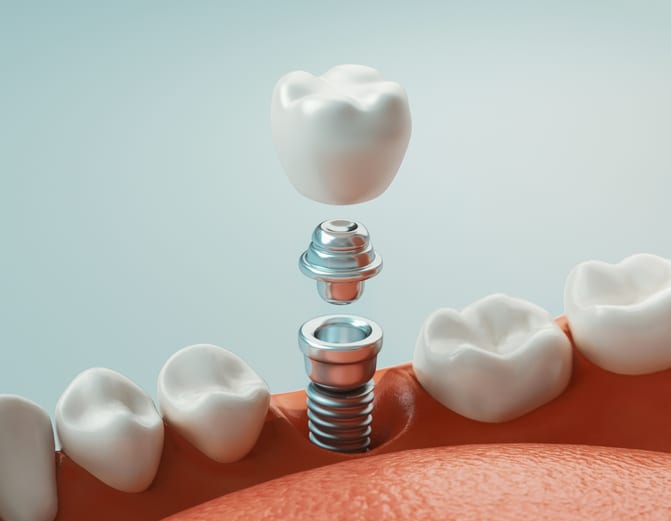 Dental Implant Plano, TX 