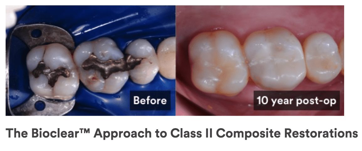 Bioclear method for old dental fillings