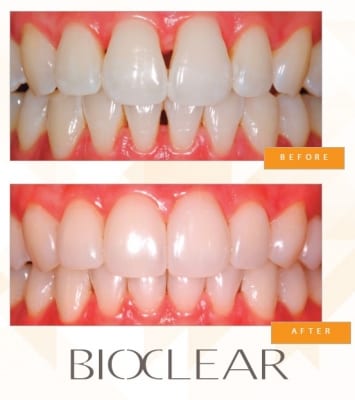 Bioclear method for gaps between teeth
