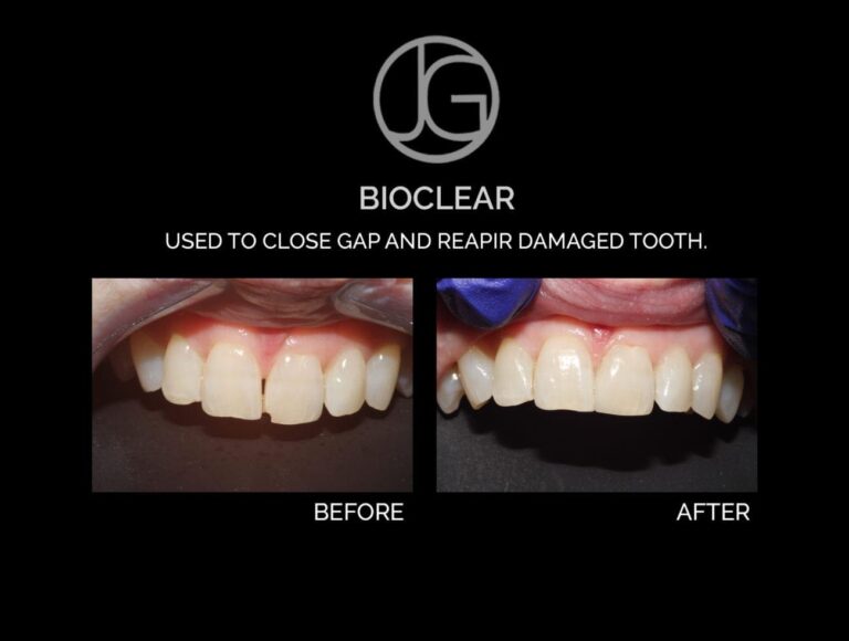 Dental patient before and after Bioclear From Dr. Grapevine