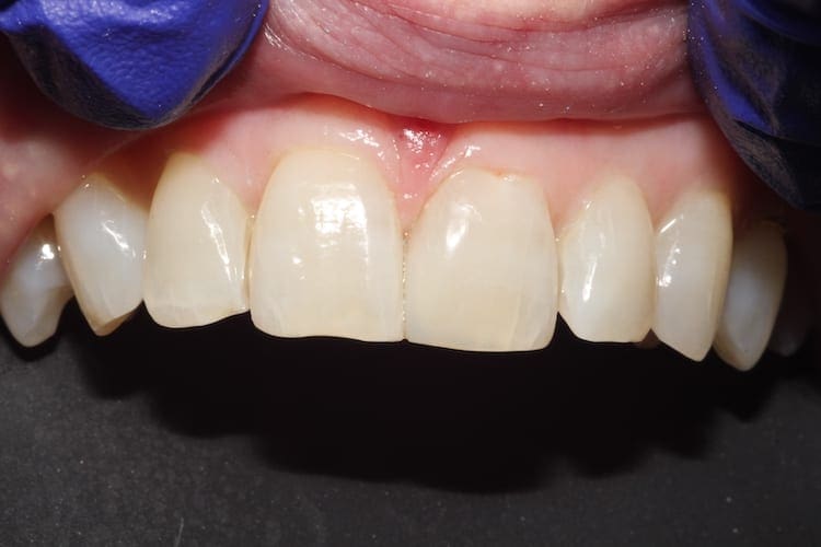 after cosmetic dentistry