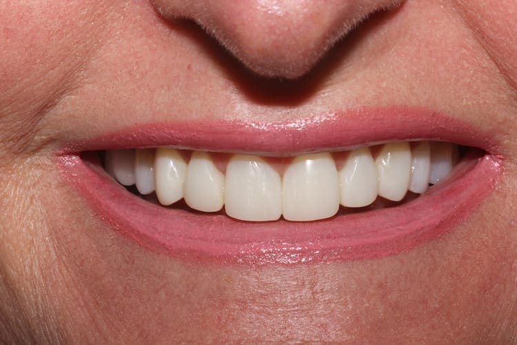 after cosmetic dentistry