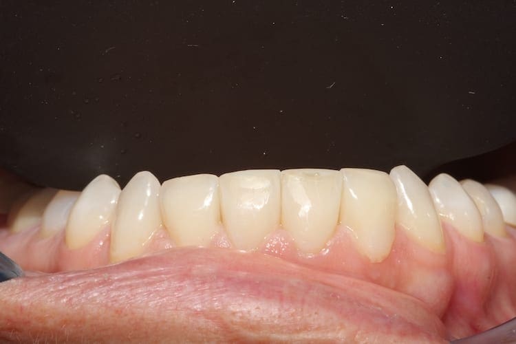 after cosmetic dentistry