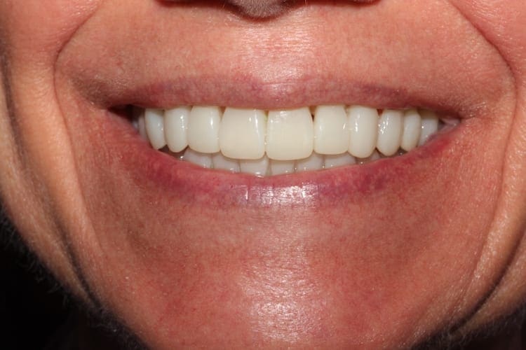 after cosmetic dentistry