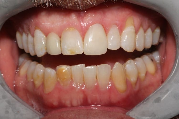 after cosmetic dentistry