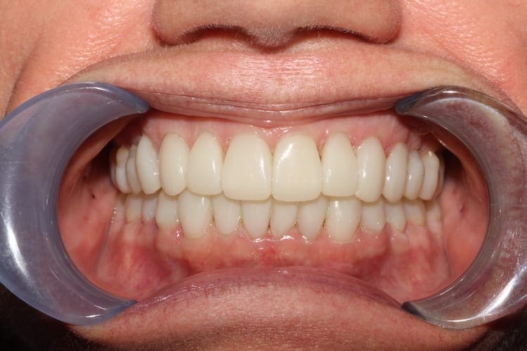 after cosmetic dentistry