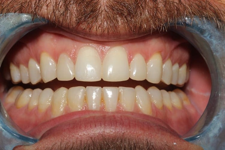 after cosmetic dentistry