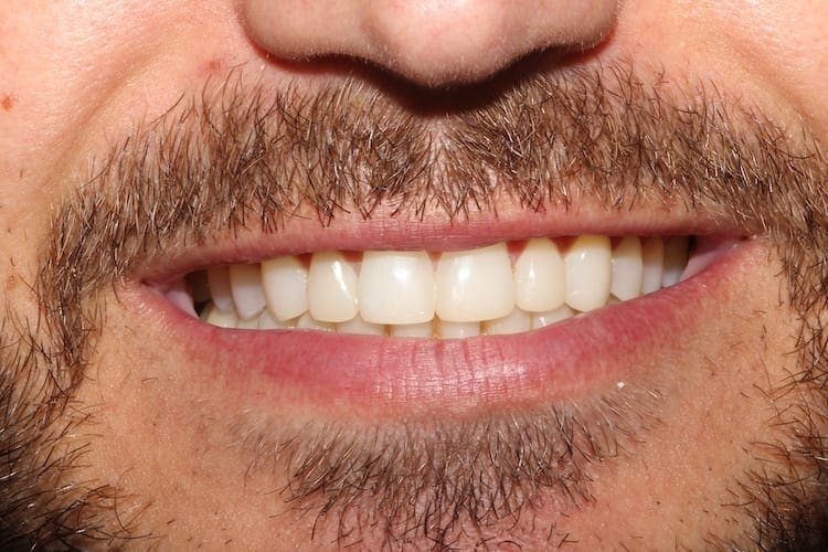 after cosmetic dentistry