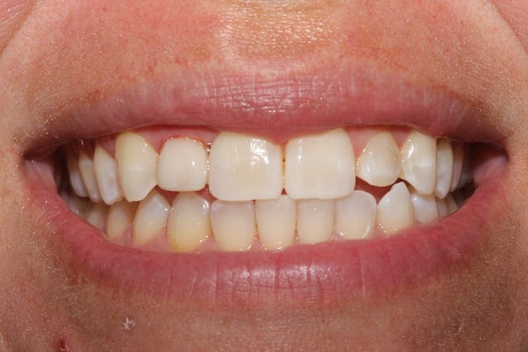 after cosmetic dentistry