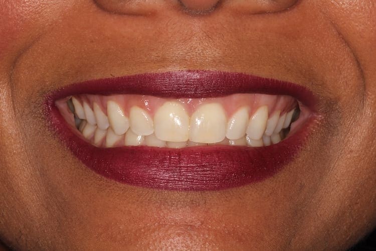 after cosmetic dentistry