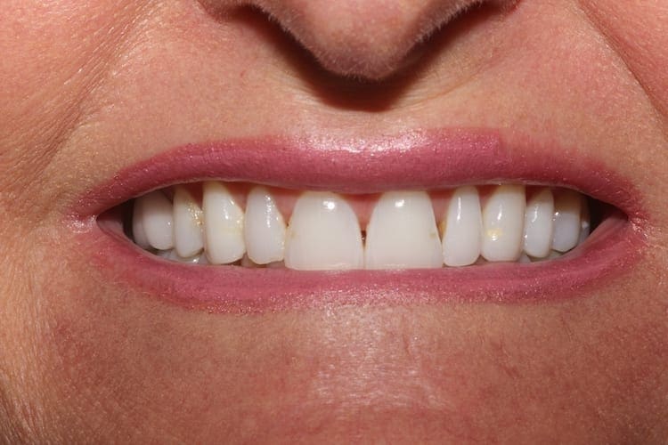 before cosmetic dentistry