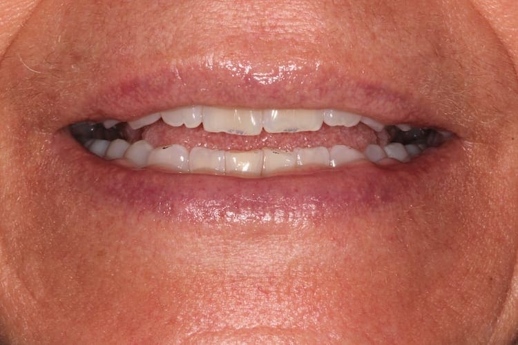 before cosmetic dentistry