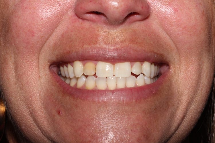 before cosmetic dentistry