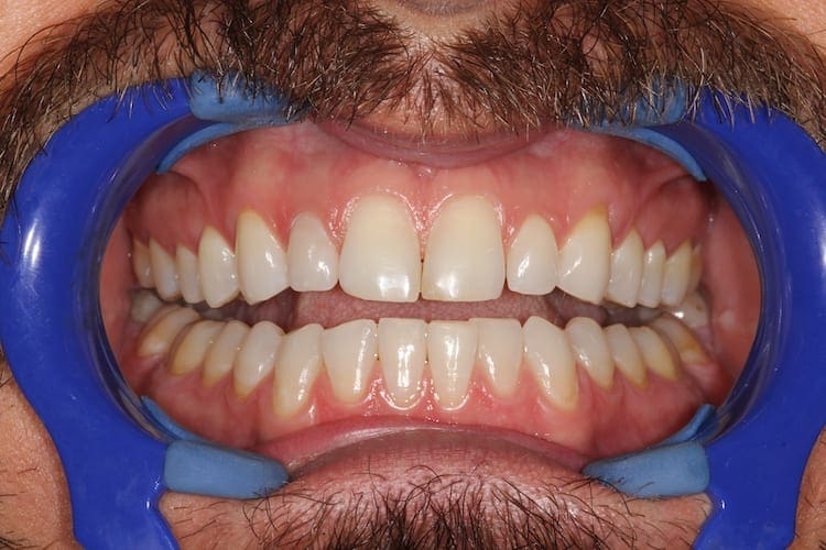 before cosmetic dentistry