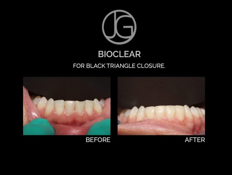 bioclear blacktriangle closure