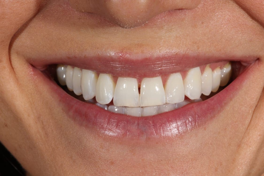 before cosmetic dentistry